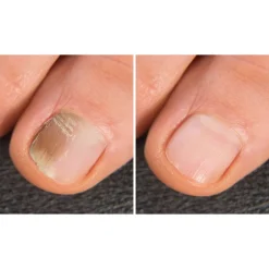 Anti-Fuss- und Nagelpilzspray, 100 ml