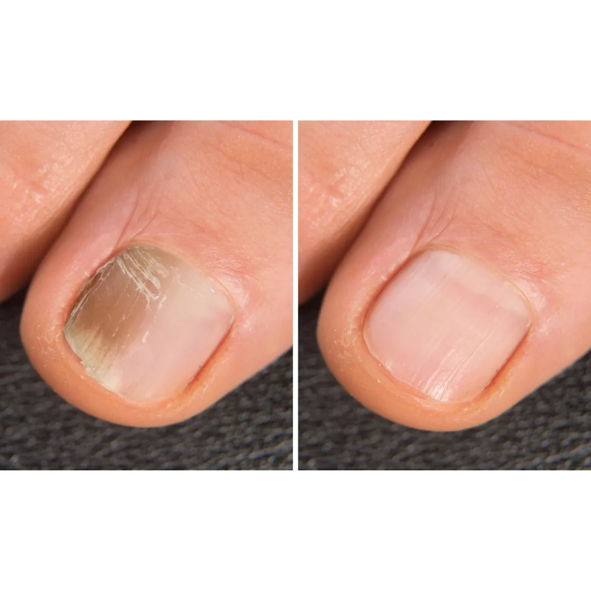 Anti-Fuss- und Nagelpilzspray, 100 ml