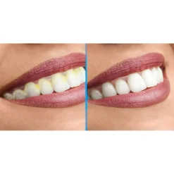 DentaPic Sonic Schall-Zahnreiniger