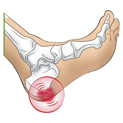 Fersenspornkissen, 1 Paar Herren