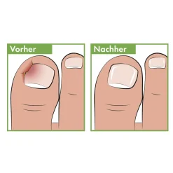 Pediküre Eckenfeile